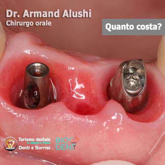 Dentista-in-Albania-con-clinica-dentale-a-Tirana-per-turismo-dentale-due-impianti-dentali-per-ponte-di-3-denti