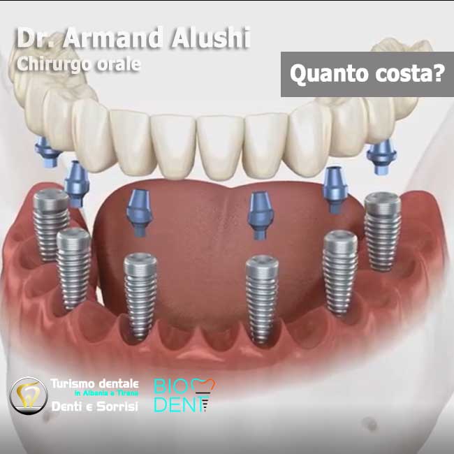 Dentista-in-Albania-con-clinica-dentale-a-Tirana-per-turismo-dentale-6-impianti-dentali-All-on-Six-vantaggi-e-svantaggi