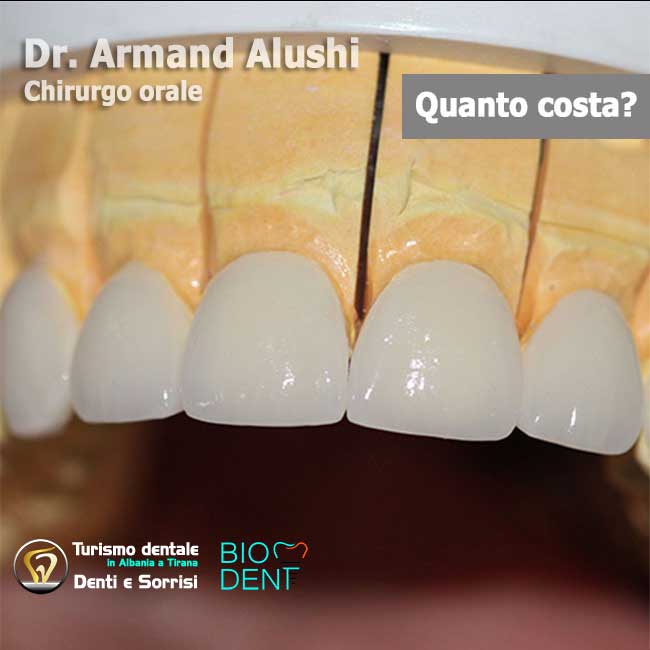 Dentista-in-Albania-con-clinica-dentale-a-Tirana-per-turismo-dentale-denti-in-metallo-ceramica-per-estetica-dentale