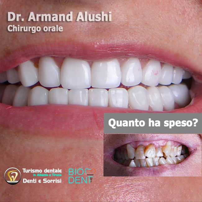 Dentista-in-Albania-con-clinica-dentale-a-Tirana-per-turismo-dentale-all-on-four-8-impianti-dentali-con-24-corone-in-zirconio