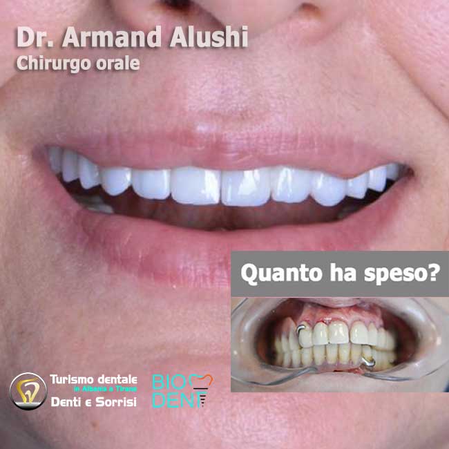 Dentista-in-Albania-con-clinica-dentale-a-Tirana-per-turismo-dentale-all-on-six-arcata-superiore-e-arcata-inferiore-con-12-impianti-dentali-e-24-corone-in-zirconio