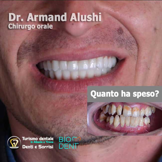 Dentista-in-Albania-con-clinica-dentale-a-Tirana-per-turismo-dentale-inserimento-di-3-impianti-dentali-più-cure-dei-denti-e-l'applicazione-di-24-corone-in-zirconio