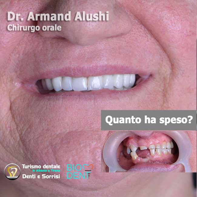 Dentista-in-Albania-con-clinica-dentale-a-Tirana-per-turismo-dentale-implantologia-di-4-impianti-dentali-un-aumento-osseo-per-posizione-dente-e-24-corone-in-zirconio