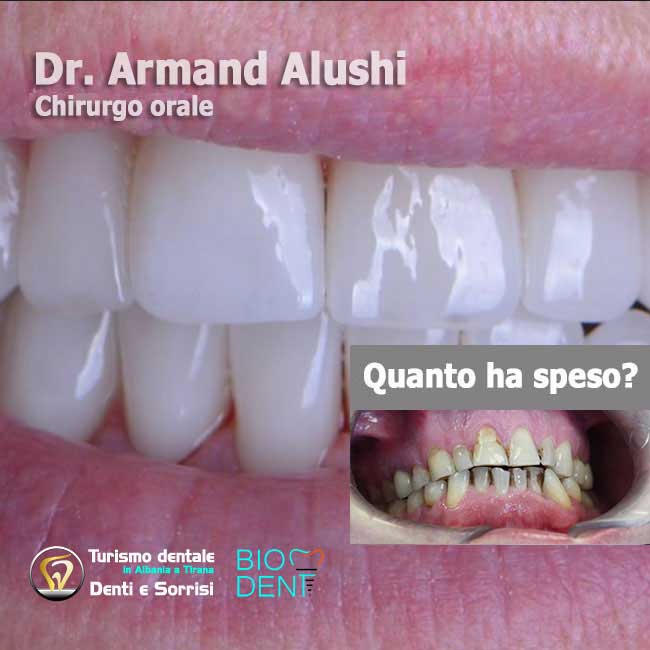 Dentista-in-Albania-con-clinica-dentale-a-Tirana-per-turismo-dentale-cure-canalarie-e-cure-carie-e-preparazione-dei-denti-con-limatura-per-l'applicazione-di-24-corone-in-zirconio