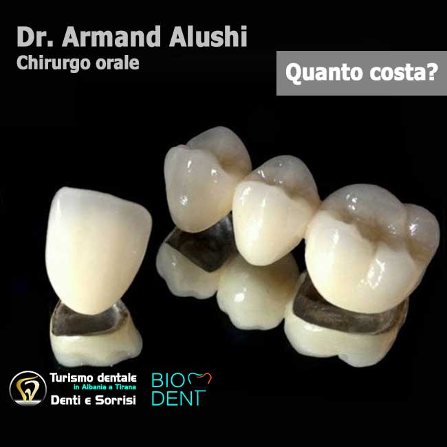 Dentista-in-Albania-con-clinica-dentale-a-Tirana-per-turismo-dentale-denti-corone-o-capsule-e-ponti-in metallo-ceramica