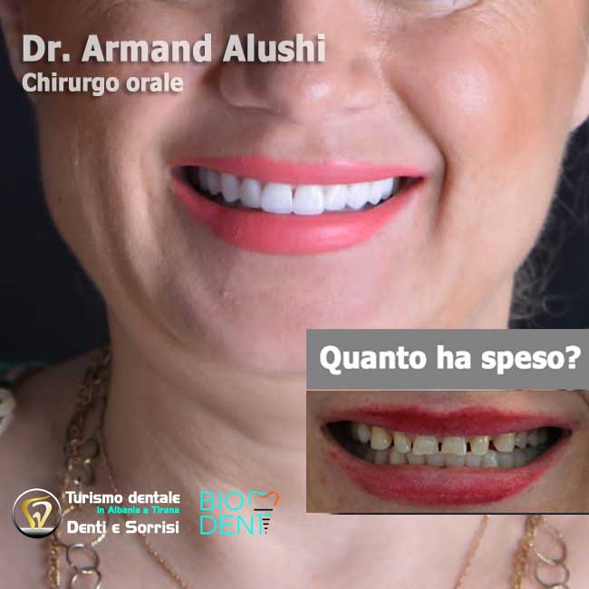 Dentista-in-Albania-con-clinica-dentale-a-Tirana-per-turismo-dentale-estetica-dentale-senza-cure-dentali-di-24-corone-in-zirconio-applicate-sui-propri-denti