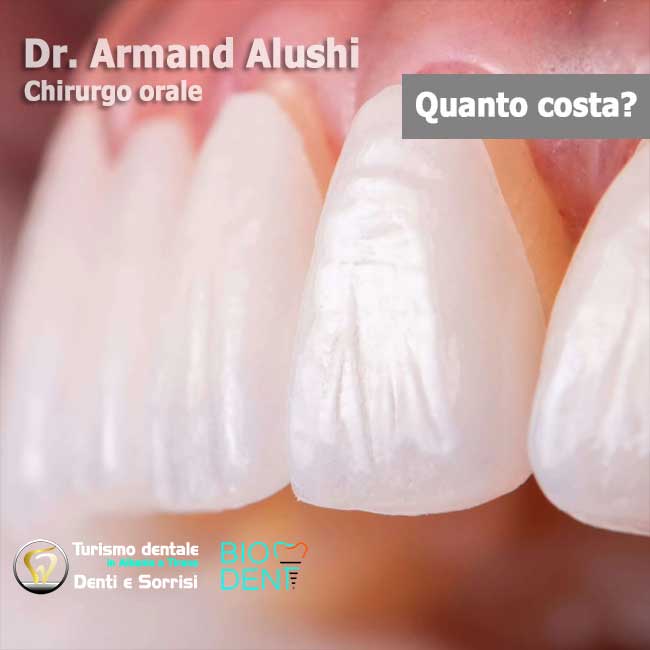 Dentista-in-Albania-con-clinica-dentale-a-Tirana-per-turismo-dentale-faccette-dentali-Emax