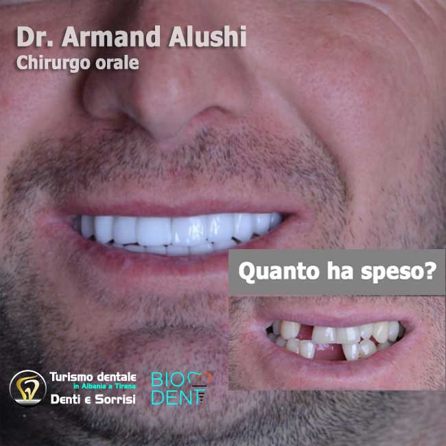 Dentista-in-Albania-con-clinica-dentale-a-Tirana-per-turismo-dentale-implantologia-di-4-impianti-dentali-con-cure-dentali-e-l'applicazione-di-24-corone-in-zirconio