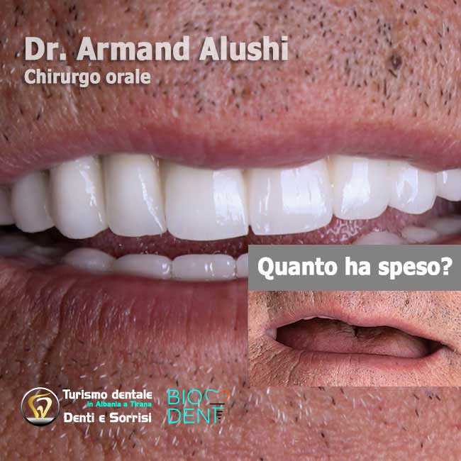 Dentista-in-Albania-con-clinica-dentale-a-Tirana-per-turismo-dentale-estrazione-dei-denti-con-implantologia-di-12-impianti-dentali-con-corone-in-zirconio