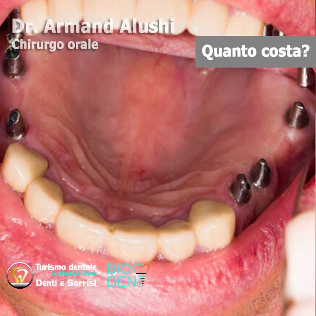 Dentista-in-Albania-con-clinica-dentale-a-Tirana-per-turismo-dentale-Impianti-dentali-per-ripristino-arcate-dentali