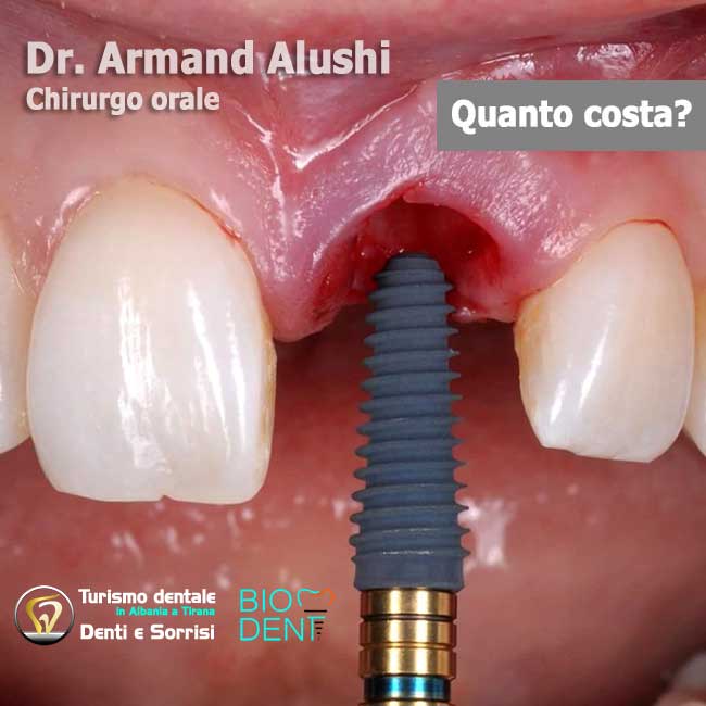 Dentista-in-Albania-con-clinica-dentale-a-Tirana-per-turismo-dentale-Impianto-dentale-per-dente-singolo
