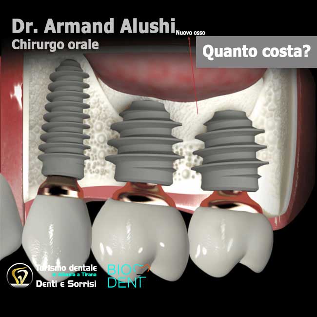 Dentista-in-Albania-con-clinica-dentale-a-Tirana-per-turismo-dentale-Rialzo-del-seno-mascellare