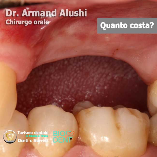 Dentista-in-Albania-con-clinica-dentale-a-Tirana-per-turismo-dentale-aumento-osso-innesto-osso-per-posizione-dente