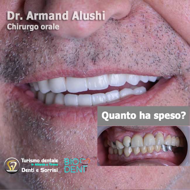 Dentista-in-Albania-con-clinica-dentale-a-Tirana-per-turismo-dentale-sostituzione-di-vecchie-corone-in-metallo-ceramica-con-24-corone-in-zirconio-con-cure-dentali